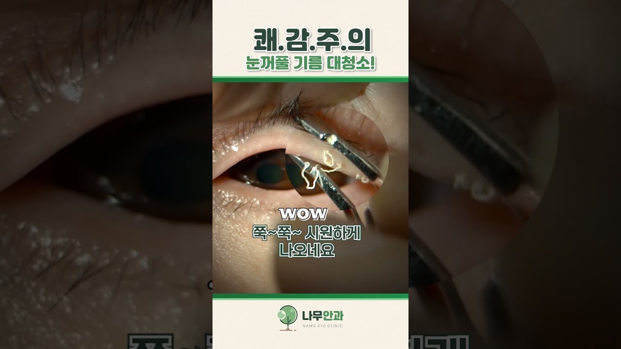 눈이 자꾸 건조하다면? 기름샘이 막혔을 확률 99% 